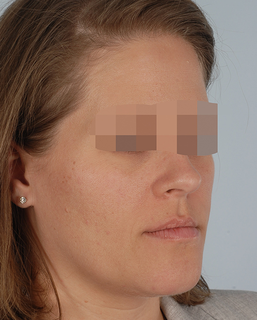 Malocclusion Case 3356 Before Photo Malocclusion