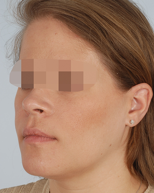 Malocclusion Case 3356 After Photo Malocclusion