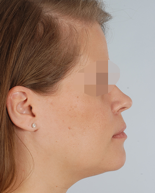 Malocclusion Case 3356 After Photo Malocclusion