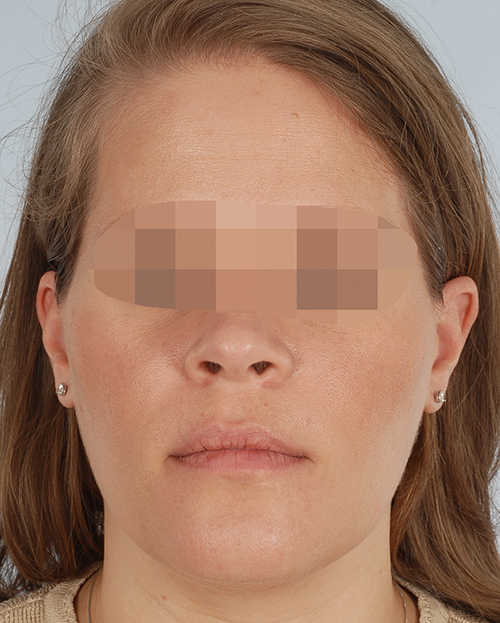 Malocclusion Case 3356 After Photo Malocclusion