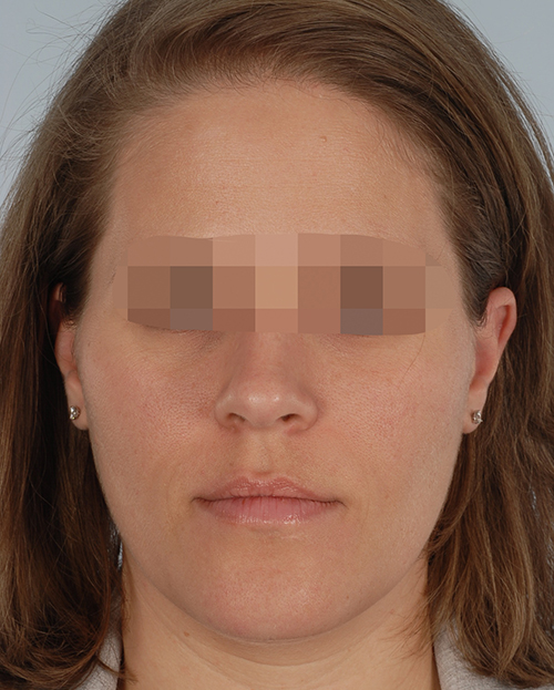 Malocclusion Case 3356 Before Photo Malocclusion