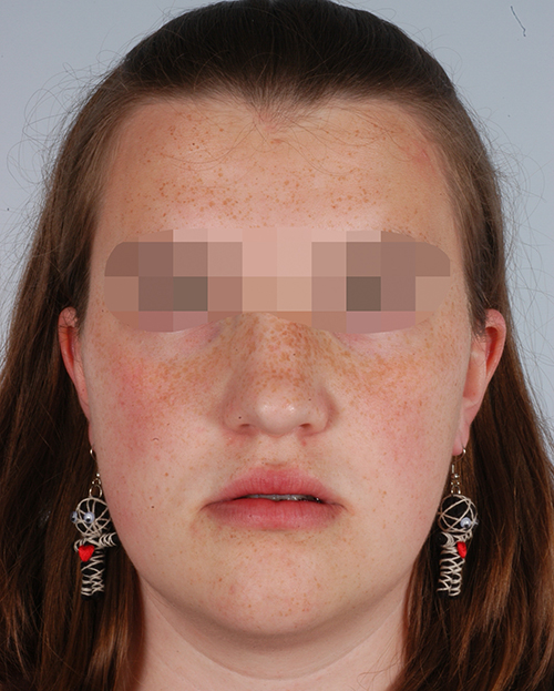 Malocclusion Case 3358 After Photo Malocclusion