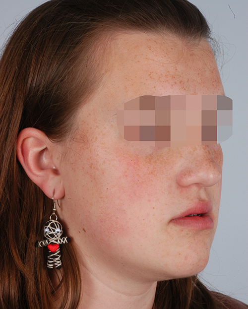 Malocclusion Case 3358 After Photo Malocclusion