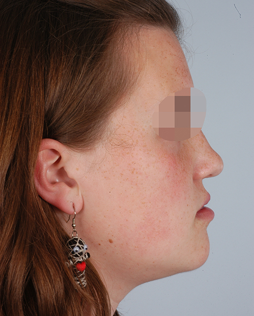 Malocclusion Case 3358 After Photo Malocclusion