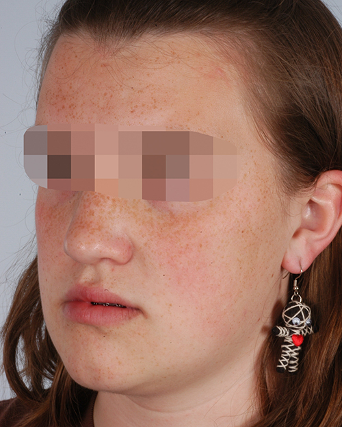 Malocclusion Case 3358 After Photo Malocclusion