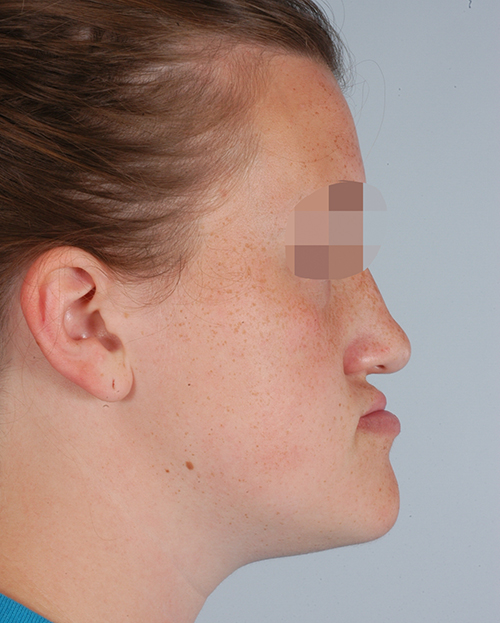 Malocclusion Case 3358 Before Photo Malocclusion