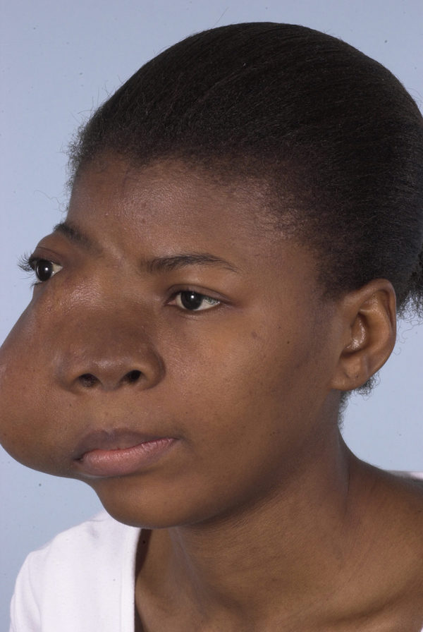 Facial Reconstruction Case 2733 Before Photo Facial Reconstruction