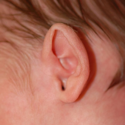 Abnormal Ear Shape - EarWell (Ear Molding)