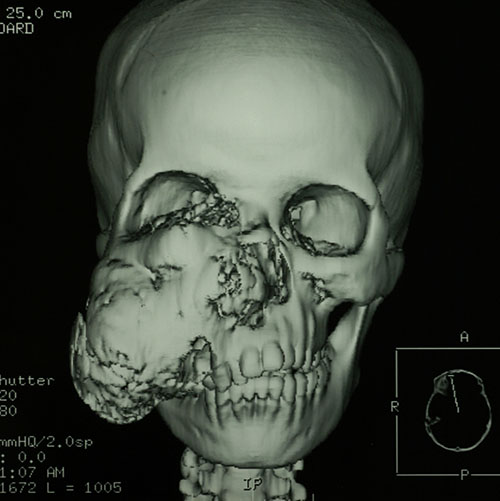 Facial Reconstruction Case 2733 Before Photo Facial Reconstruction
