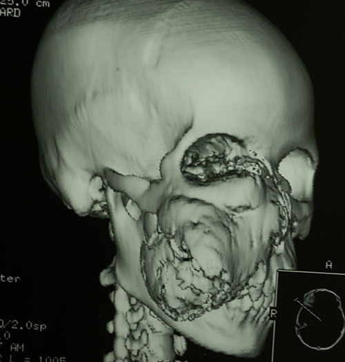 Facial Reconstruction Case 2733 Before Photo Facial Reconstruction