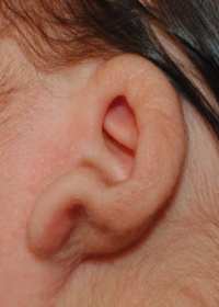 Ear Molding