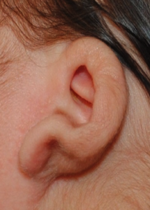 Infants darwin's tubercle covering inner ear, Ear Molding, Washington DC