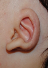 Ear Molding