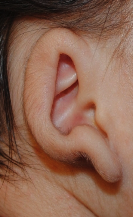 Ear Molding