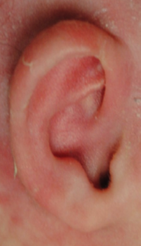 Ear Molding