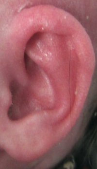 Ear Molding