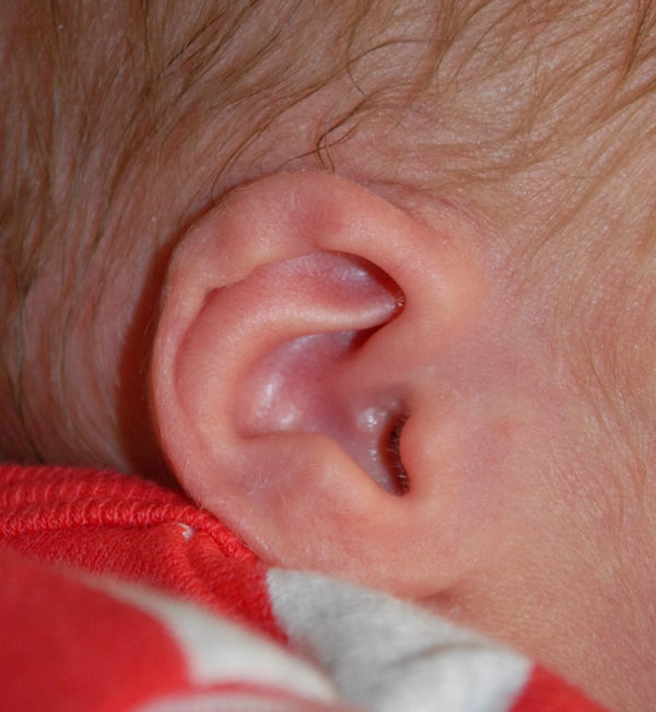 Ear Molding Case 3923 Before Photo Ear Molding