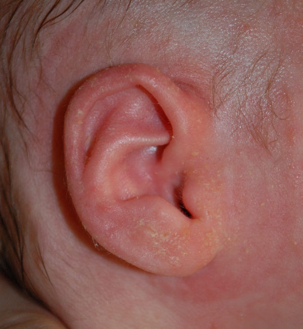 Ear Molding Case 3923 After Photo Ear Molding