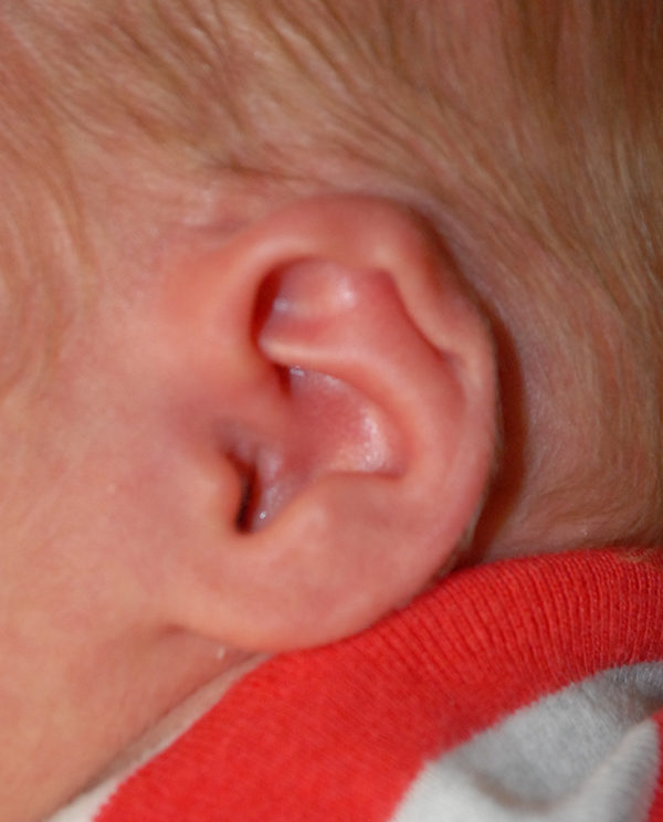 Ear Molding Case 3923 Before Photo Ear Molding