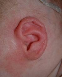 Ear Molding