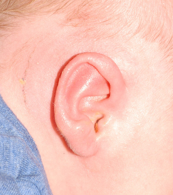 Ear Molding