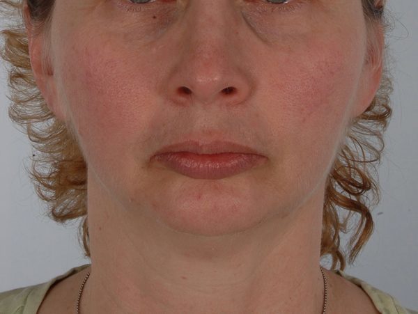 Perioral Rejuvenation Case 3848 Before Photo Perioral Rejuvenation