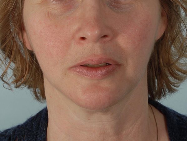 Perioral Rejuvenation Case 3848 After Photo Perioral Rejuvenation
