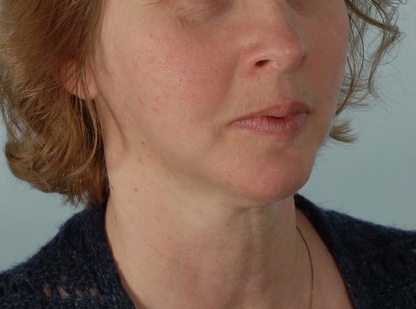 Perioral Rejuvenation Case 3848 After Photo Perioral Rejuvenation