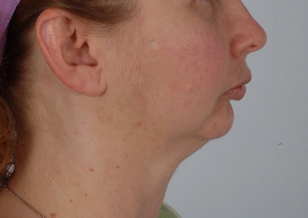 Perioral Rejuvenation Case 3848 Before Photo Perioral Rejuvenation