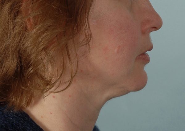 Perioral Rejuvenation Case 3848 After Photo Perioral Rejuvenation