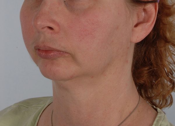 Perioral Rejuvenation Case 3848 Before Photo Perioral Rejuvenation