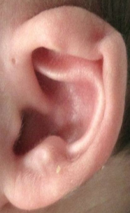 Ear Molding