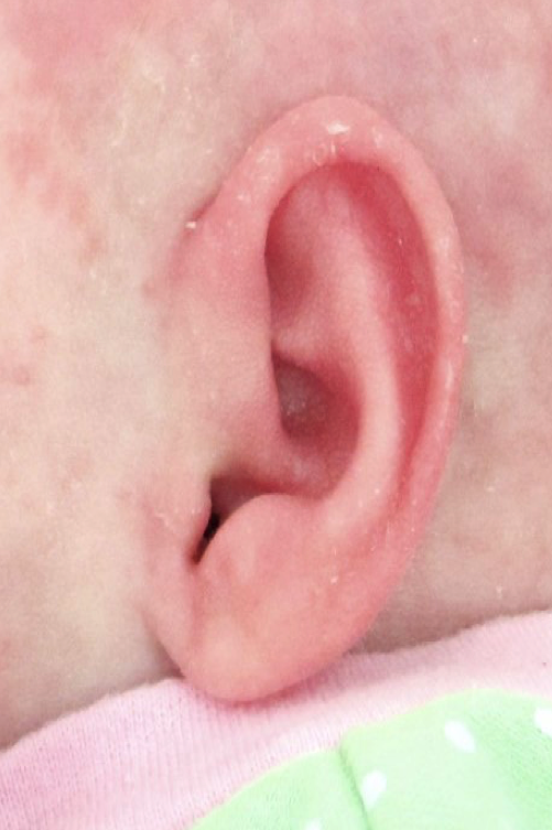 Ear Molding