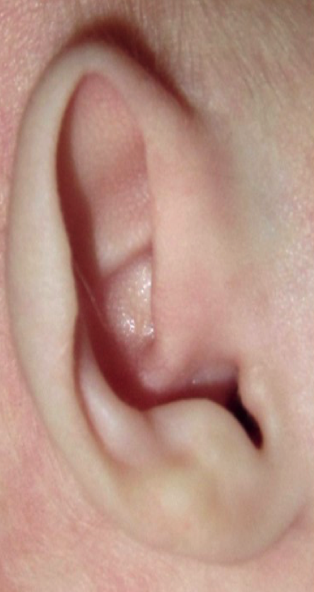 Ear Molding