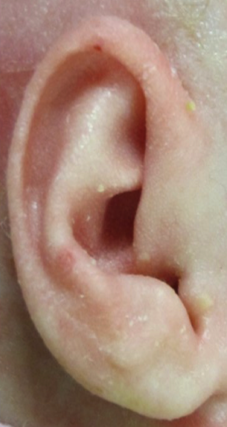 Ear Molding