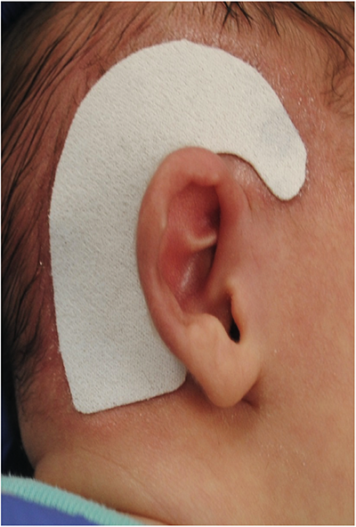 Infant Ear base - EarWell (Ear Mold)