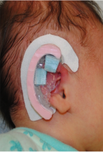 Infant Right ear with silicone gel, Ear Molding, Washington DC