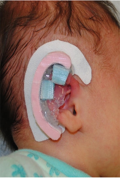 Ear Silicone Gel