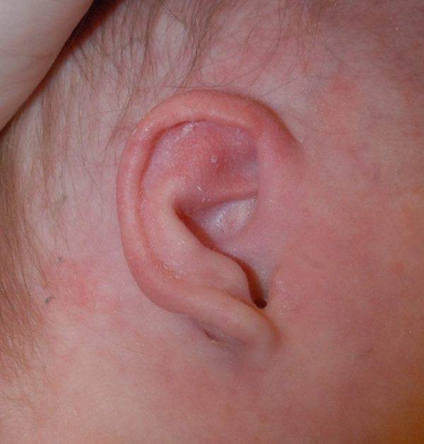 Ear Molding