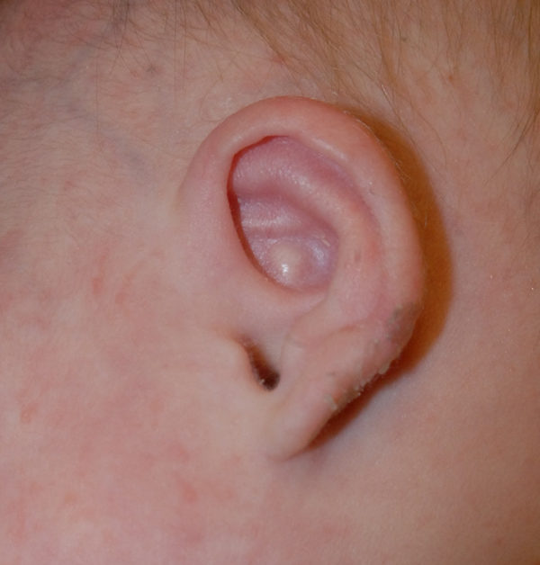 Ear Molding