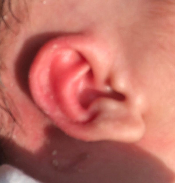 Ear Molding