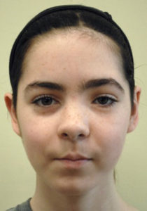 Beautiful kid after Face Reconstruction, Mclean Falls Church VA Washington DC