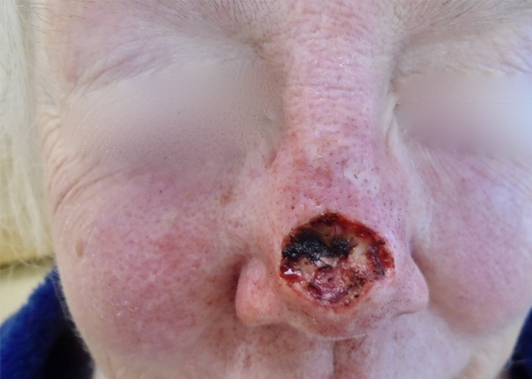 Skin Cancer Case 4105 Before Photo Skin Cancer
