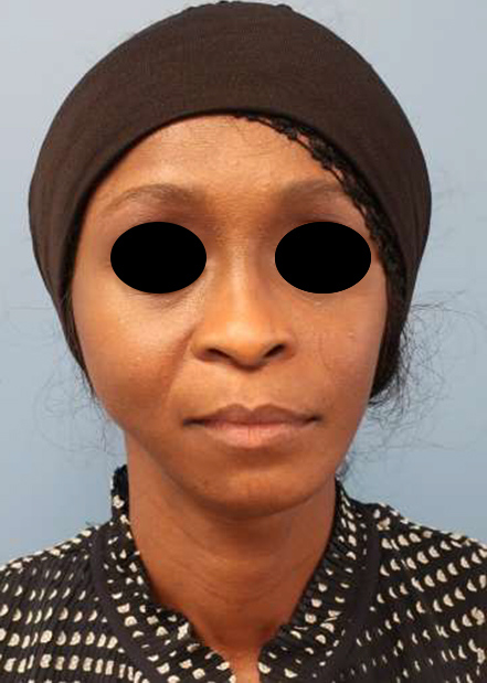 Asymmetry and Facial Reshaping Case 4115 Before Photo Asymmetry and Facial Reshaping