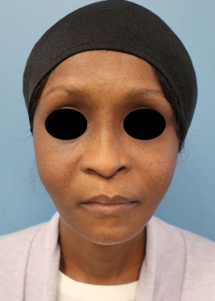 Asymmetry and Facial Reshaping Case 4115 After Photo Asymmetry and Facial Reshaping