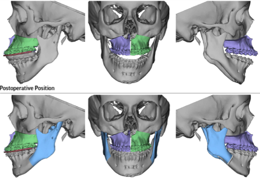 jaw-sugery-surgeon