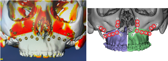 jaw-sugery-surgeon