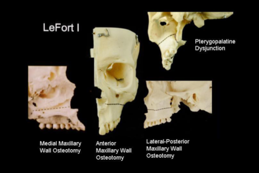 jaw-sugery-surgeon