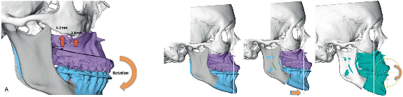 jaw-sugery-surgeon