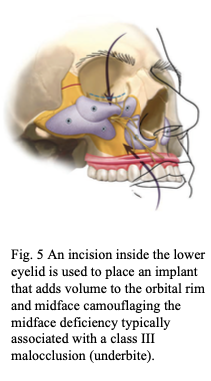 Orthognathic Camouflage Orthognathic Camouflage Procedure Washington DC